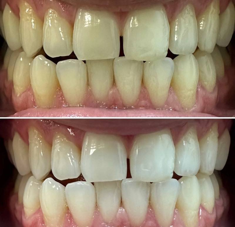 Before & After Teeth Whitening