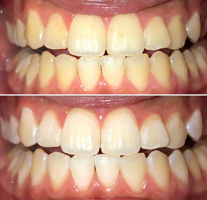 Teeth Whitening Before and After