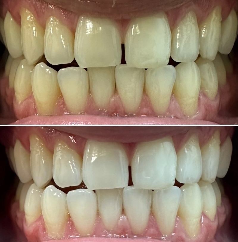 Whitening Photo